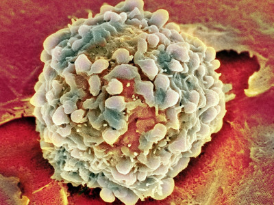 Назван главный способ уберечься от рака