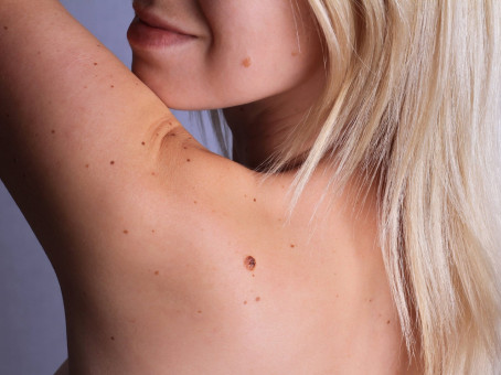 5 признаков того, что ваши родинки надо срочно показать врачу