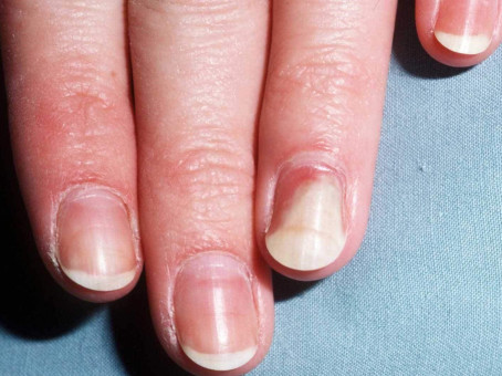 Ногти могут выдать симптом опасного заболевания