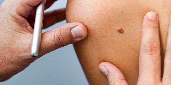С чего начинается родинка: как распознать опасность