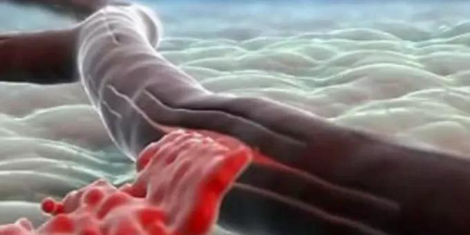 6 признаков надвигающегося инсульта: как тело предупреждает