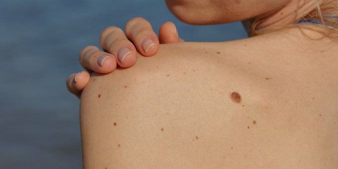 Родинка, которая говорит о том, что у вас рак