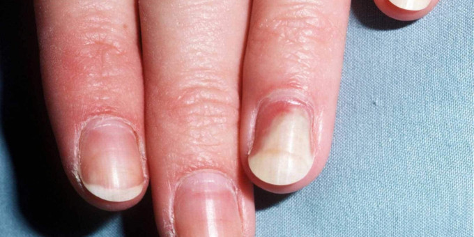 Ногти могут выдать симптом опасного заболевания