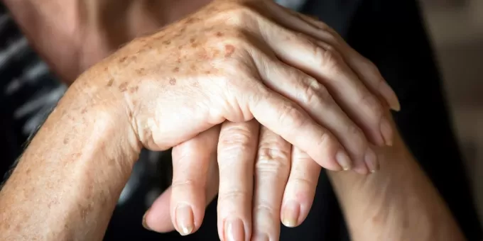 Возрастные пятна: что важно знать и как от них избавиться